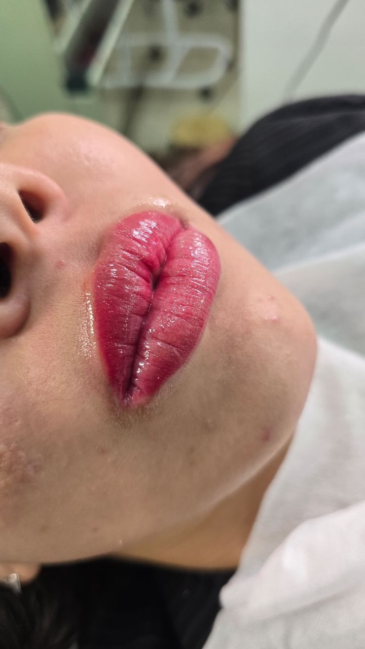 Revitalização labial
